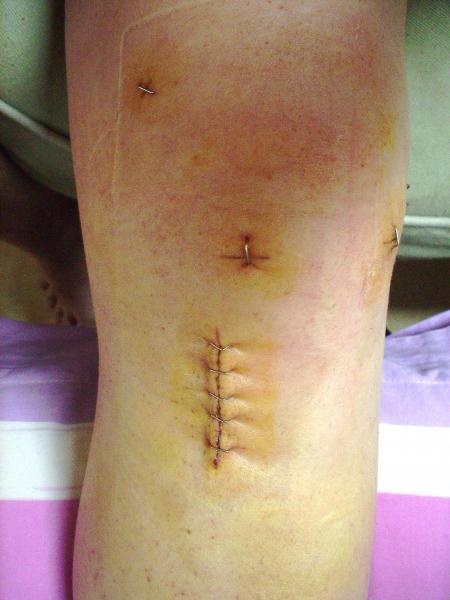 Opération ligament croisé antérieur genou gauche voila 1 semaine ...
