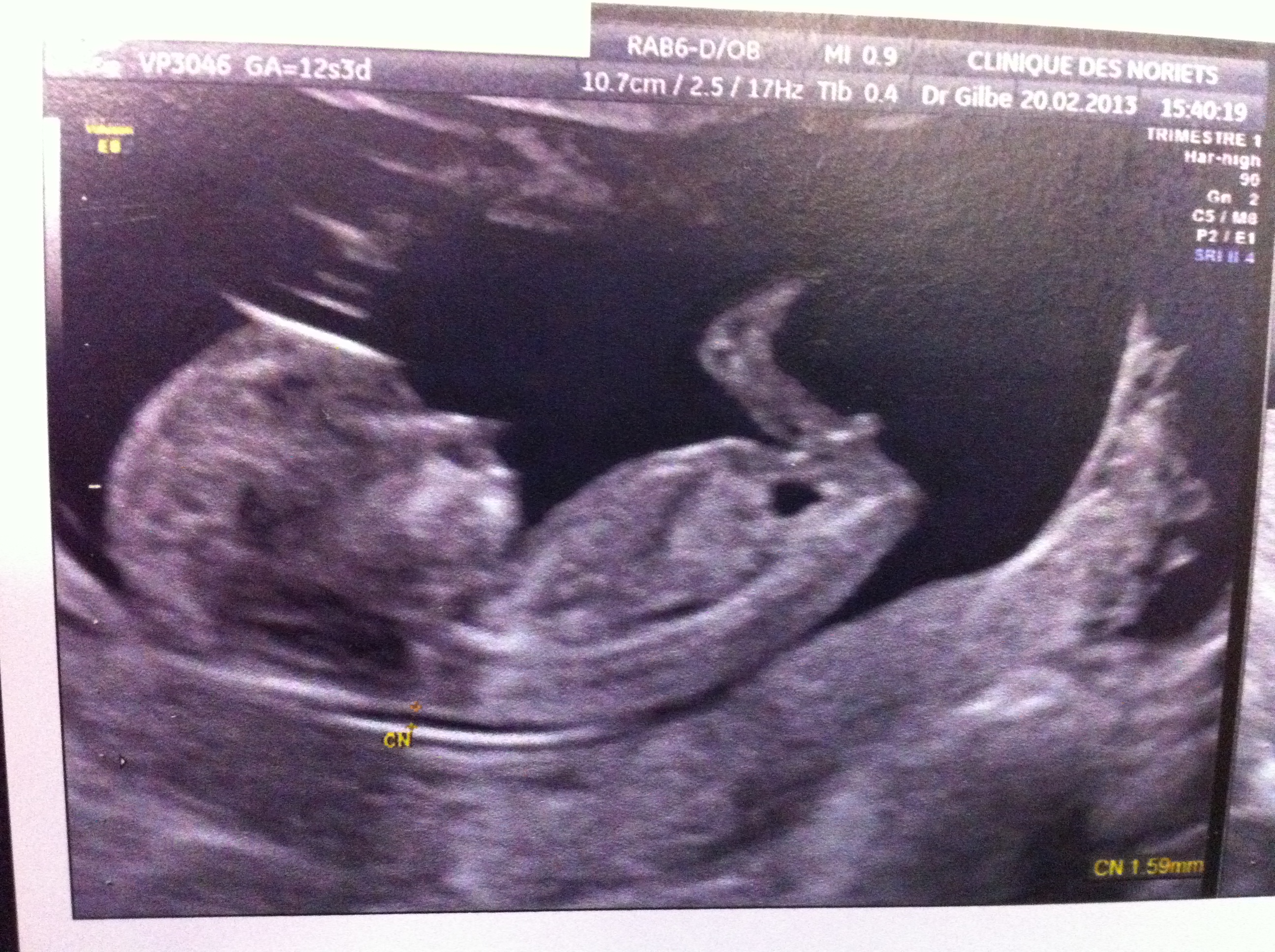 Echo 12sa Echographie Connaitre Le Sexe De Votre Bebe Forum Grossesse Amp Bebe Doctissimo Echo 12sa Echographie Connaitre Le Sexe De Votre Bebe Forum Grossesse Amp Bebe Doctissimo