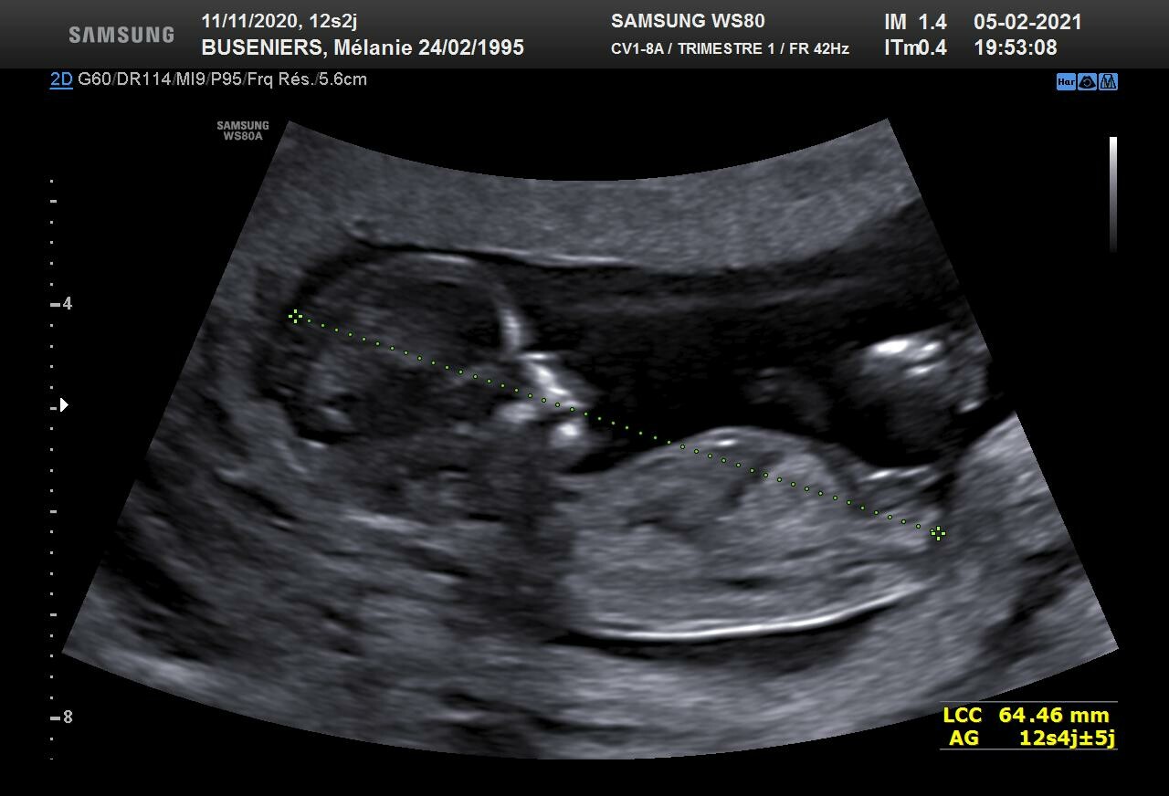 Avis Echo 12sa 4 Fille Ou Garcon Echographie Connaitre Le Sexe De Votre Bebe Forum Grossesse Amp Bebe Doctissimo