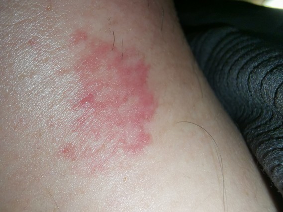 Petite plaque rouge nuque