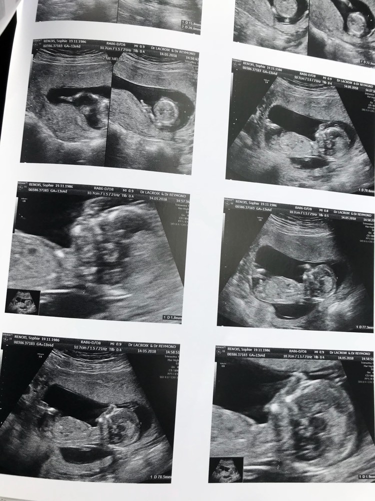 Clarte Nucale A 3 7 Amniocentese Forum Grossesse Amp Bebe Doctissimo Clarte Nucale A 3 7 Amniocentese Forum Grossesse Amp Bebe Doctissimo