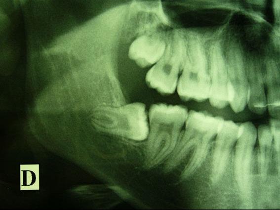 Dent De Sagesse Haut Nerf : L�intervention Peut Être À L�origine De Douleurs Modérées, De Gonflement.