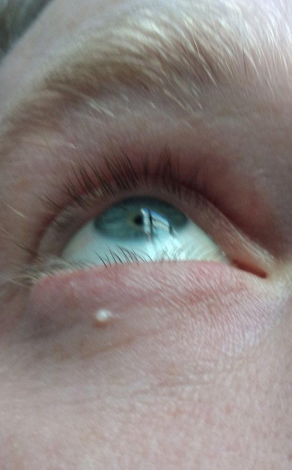 Img Bouton Blanc Oeil Vincent7691 Photos Club Doctissimo