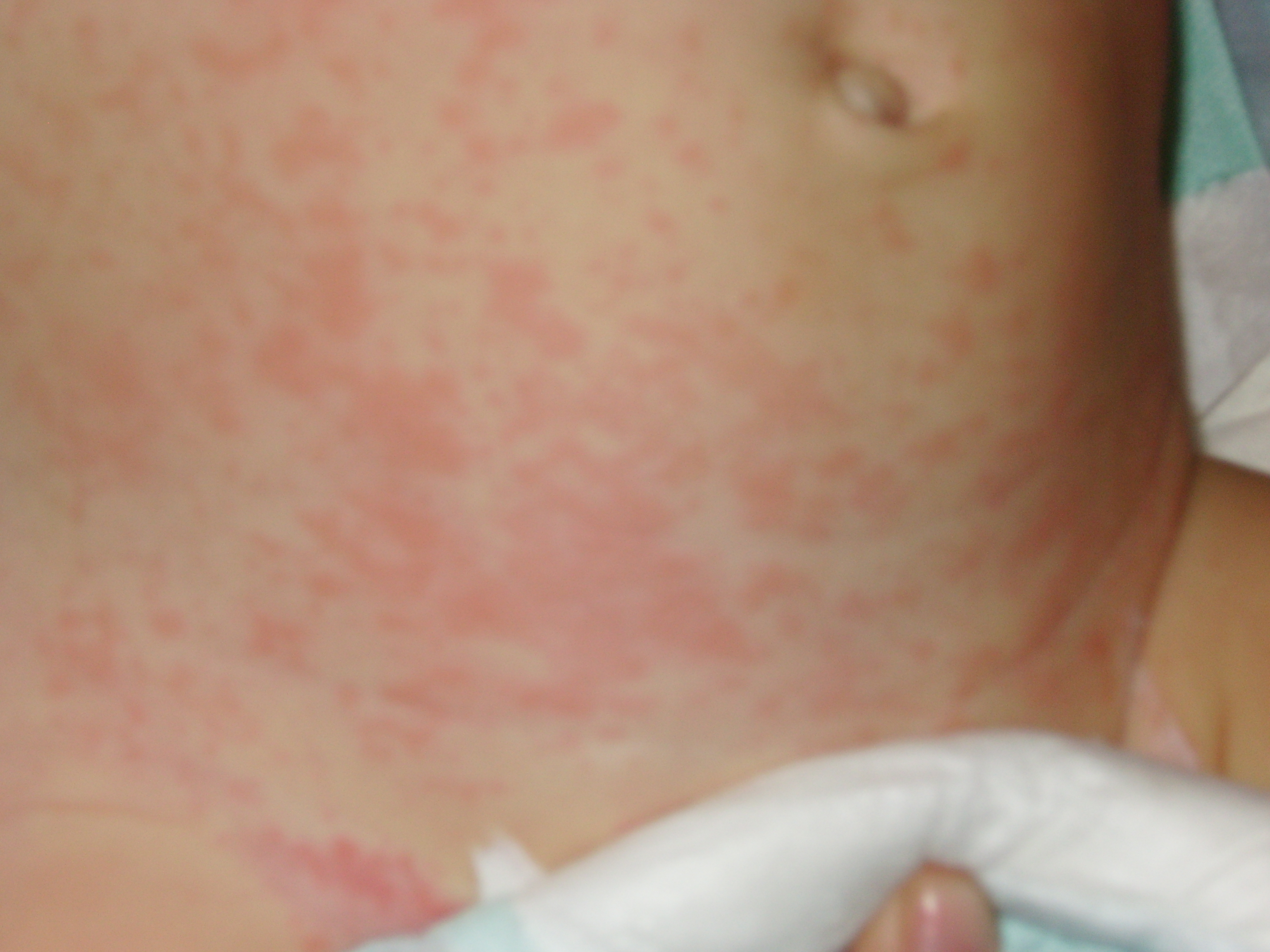 Ma Puce Est Plaine De Boutons Qui Font Des Plaques Sante De L Enfant Forum Sante Doctissimo Ma Puce Est Plaine De Boutons Qui Font Des Plaques Sante De L Enfant Forum Sante Doctissimo