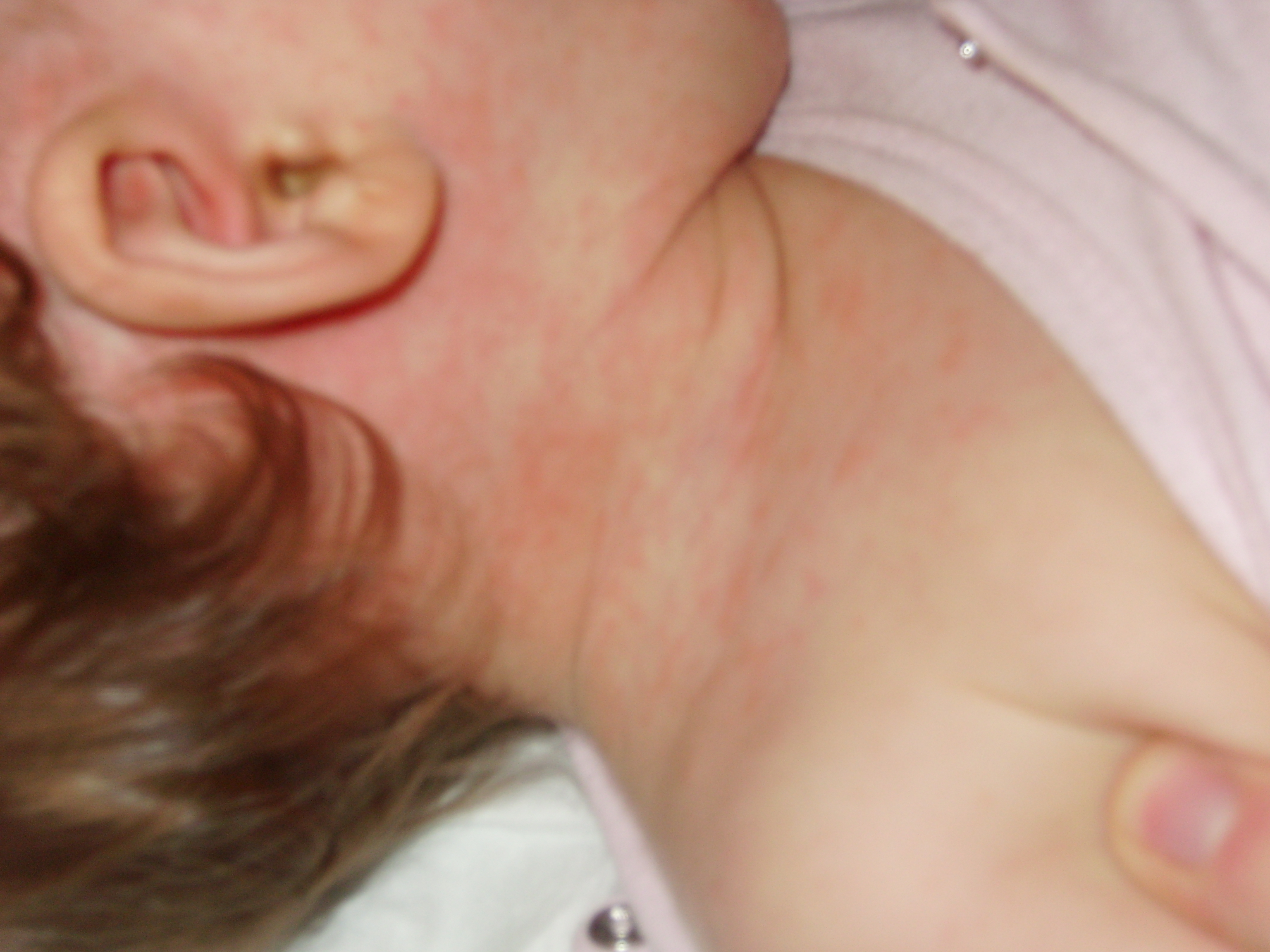 Ma Puce Est Plaine De Boutons Qui Font Des Plaques Sante De L Enfant Forum Sante Doctissimo Ma Puce Est Plaine De Boutons Qui Font Des Plaques Sante De L Enfant Forum Sante Doctissimo