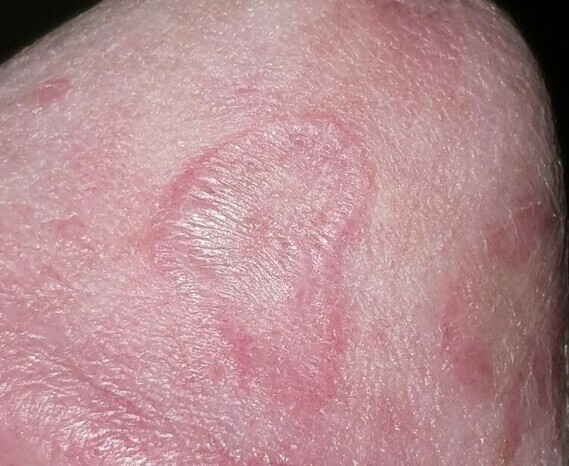 Tache rose gland - Infections sexuellement transmissibles - FORUM Santé ...