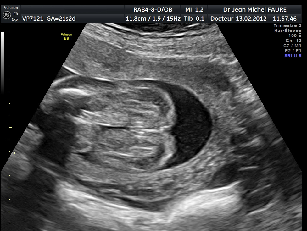 Tubercule Genital Echo 12s2j Verdict Definitif Echographie Connaitre Le Sexe De Votre Bebe Forum Grossesse Amp Bebe Doctissimo Tubercule Genital Echo 12s2j Verdict Definitif Echographie Connaitre Le Sexe De Votre Bebe Forum Grossesse Amp Bebe Doctissimo