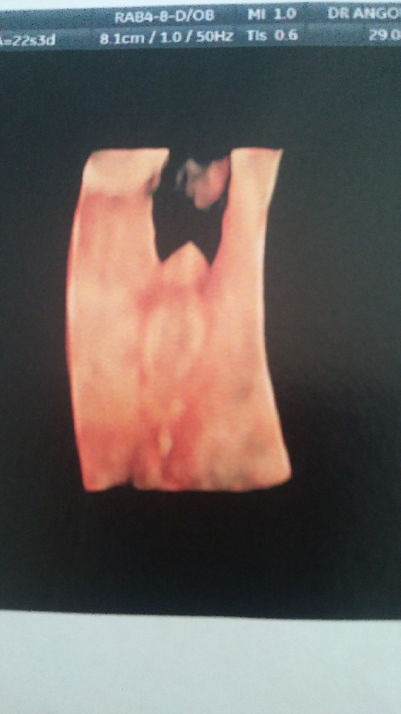 Echo 22 Sa Vos Avis Sur Un Cliche 3d Qui Me Questionne Echographie Connaitre Le Sexe De Votre Bebe Forum Grossesse Amp Bebe Doctissimo