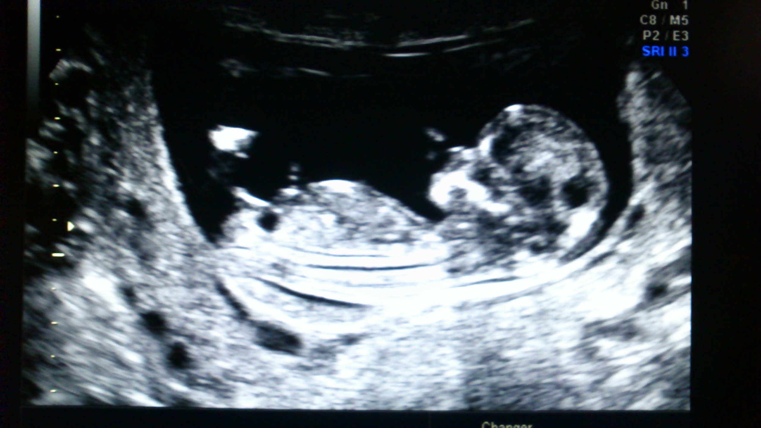 11 Sa 5 Est Ce Le Tubercule Echographie Connaitre Le Sexe De Votre Bebe Forum Grossesse Amp Bebe Doctissimo