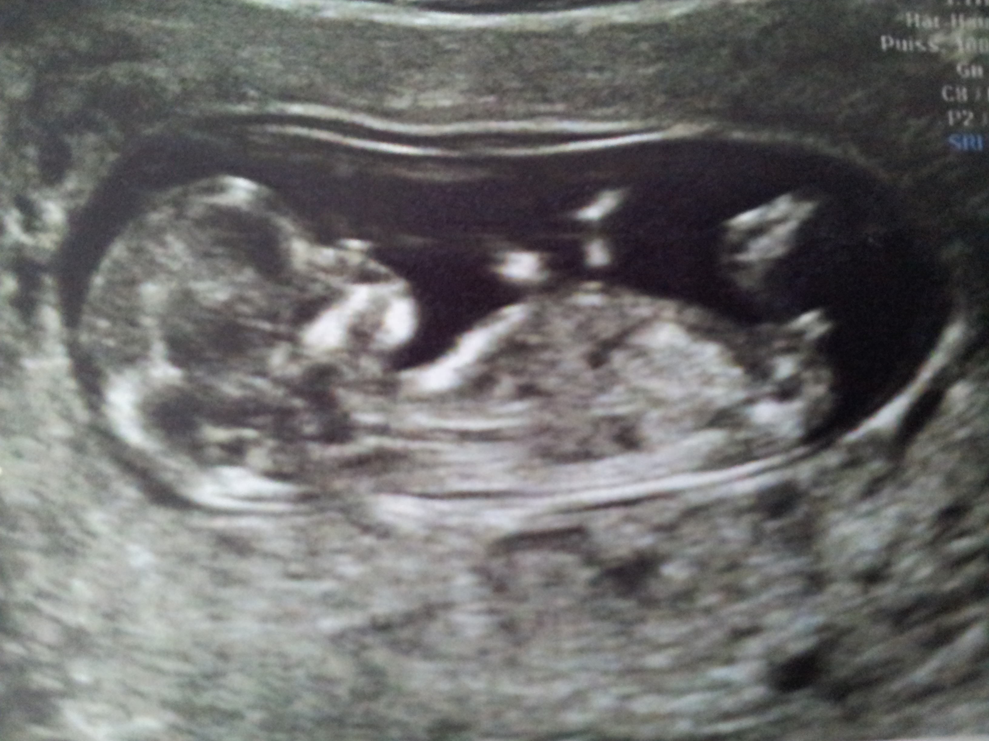 11 Sa 5 Est Ce Le Tubercule Echographie Forum Grossesse Amp Bebe Doctissimo Sistem buk se moze smatrati jednim od najsavremenijih sistema raketne pvo u svetu. forum grossesse