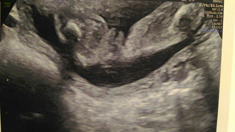 Avis Sexe Bebe 22sa Echographie Connaitre Le Sexe De Votre Bebe Forum Grossesse Amp Bebe Doctissimo Avis Sexe Bebe 22sa Echographie Connaitre Le Sexe De Votre Bebe Forum Grossesse Amp Bebe Doctissimo