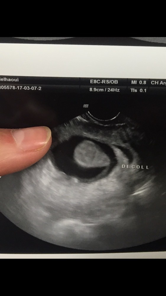 Decollement trophoblastique Decollement trophoblastique