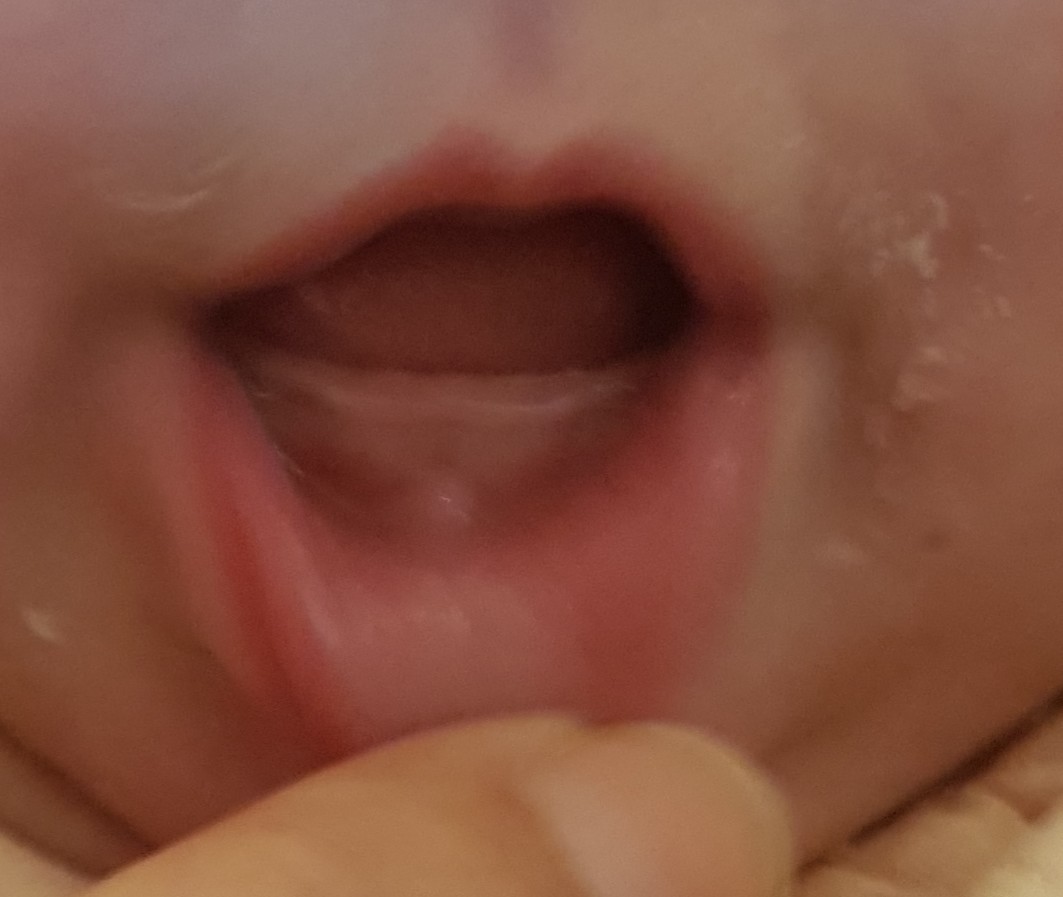 Dent Bebe 3 Mois Et Demi Sante De L Enfant Forum Sante Doctissimo Dent Bebe 3 Mois Et Demi Sante De L Enfant Forum Sante Doctissimo