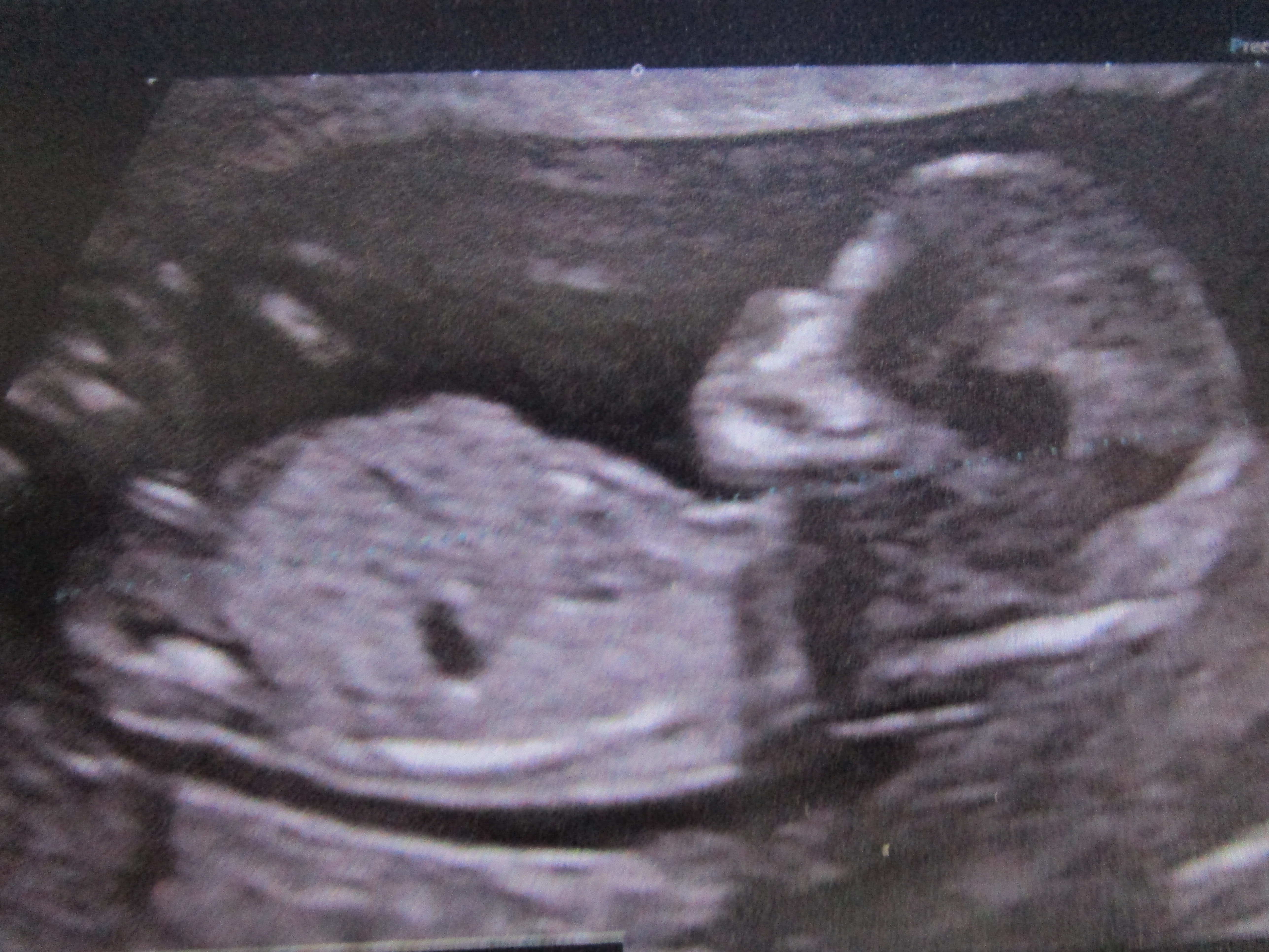 Echo 13 Sa 1 Garcon Ou Fille Echographie Connaitre Le Sexe De Votre Bebe Forum Grossesse Amp Bebe Doctissimo Echo 13 Sa 1 Garcon Ou Fille Echographie Connaitre Le Sexe De Votre Bebe Forum Grossesse Amp Bebe Doctissimo