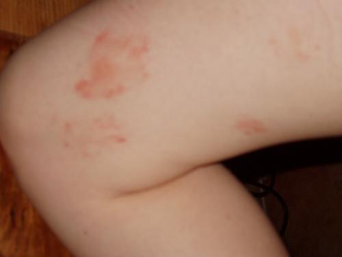 Taches Rouges Sur Le Pied Photos Acne Psoriasis Et Problemes De Peau Forum Sante