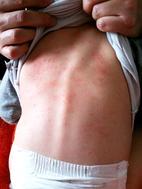 Eruption Importante Ventre Et Dos Bebe De Mois Allergies Et Eczema Forum Sante Doctissimo Eruption Importante Ventre Et Dos Bebe De Mois Allergies Et Eczema Forum Sante Doctissimo
