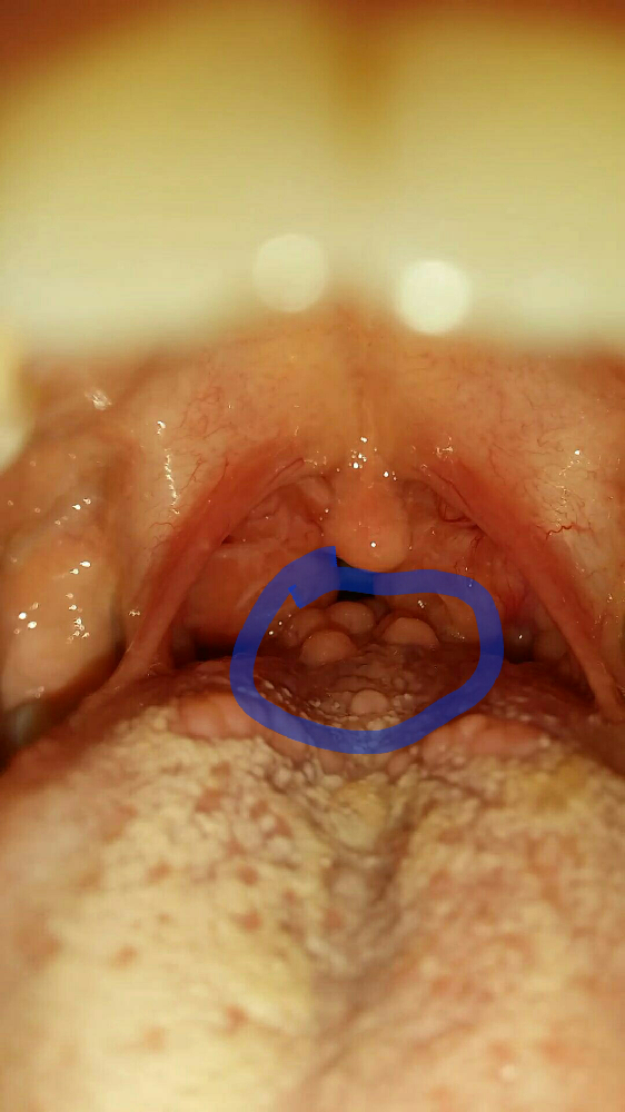 Boutons Etranges A L Arriere Langue Et Gene Dans La Gorge