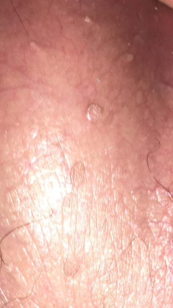 Verrues Genitales Suite Infections Sexuellement Transmissibles Forum Sante Doctissimo