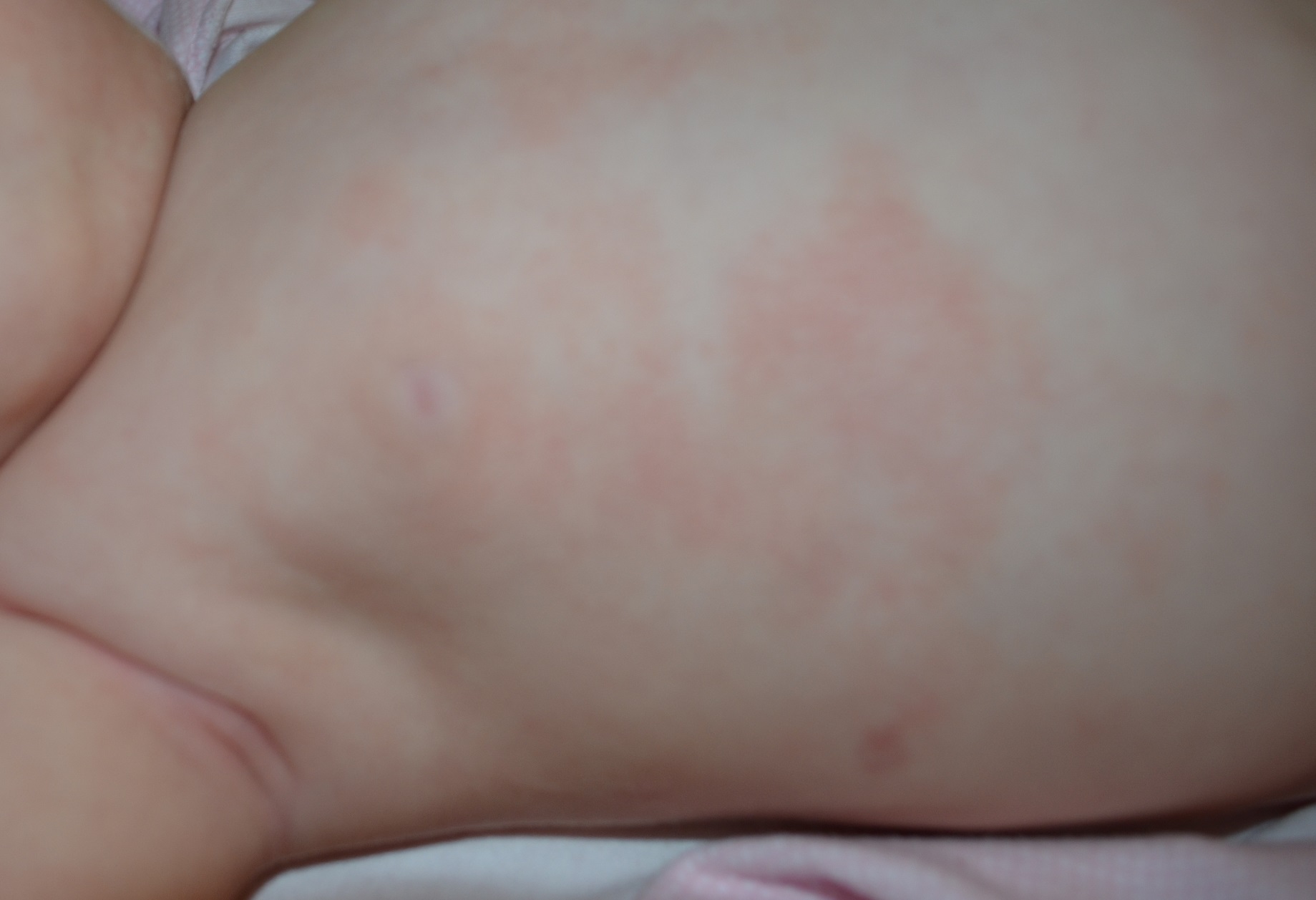 Plaques Rouges Et Seches Eczema Mamans Et Futures Mamans Du Quebec Forum Grossesse Amp Bebe Doctissimo Plaques Rouges Et Seches Eczema Mamans Et Futures Mamans Du Quebec Forum Grossesse Amp Bebe Doctissimo