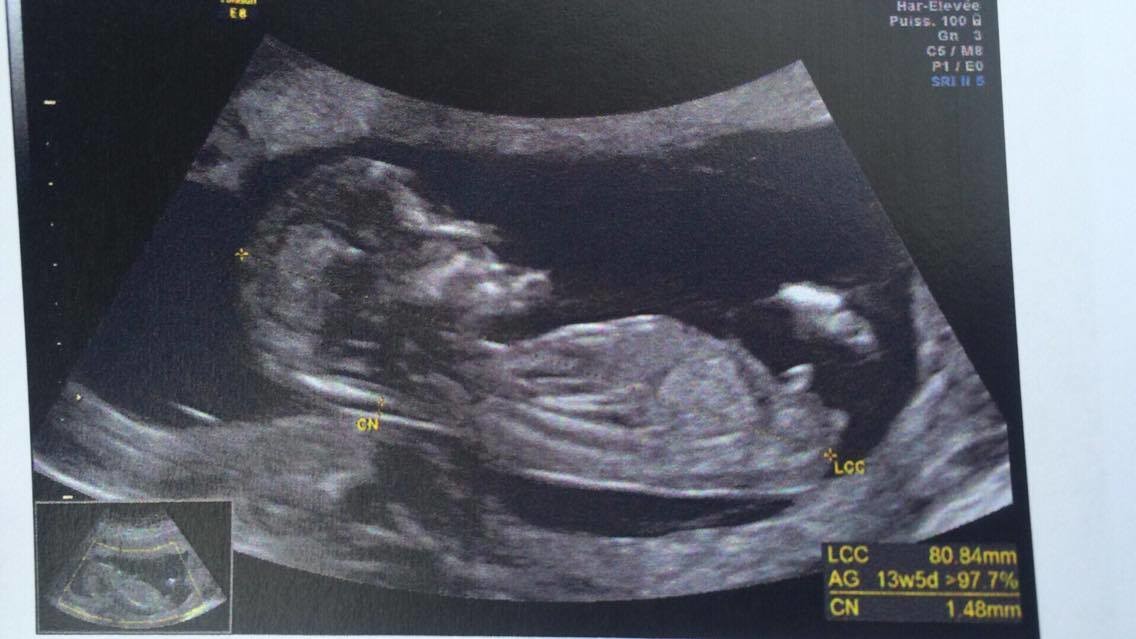 Tubercule 13sa 5 Pensez Vous Comme Gygy Echographie Connaitre Le Sexe De Votre Bebe Forum Grossesse Amp Bebe Doctissimo Tubercule 13sa 5 Pensez Vous Comme Gygy Echographie Connaitre Le Sexe De Votre Bebe Forum Grossesse Amp Bebe Doctissimo