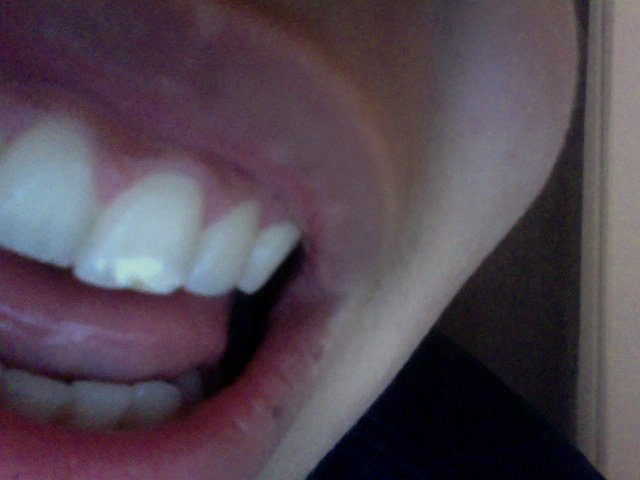 Tache A L Incisive Centrale Problemes Dentaires Forum Sante Doctissimo