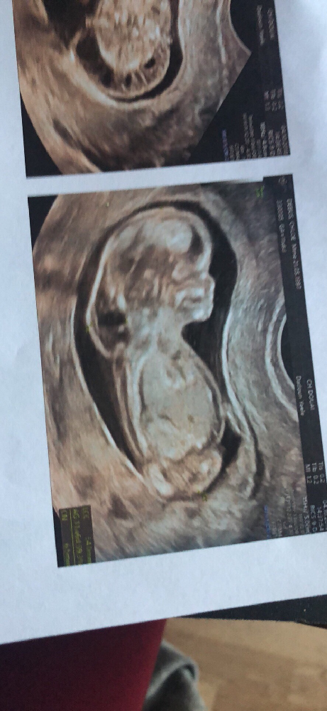 Cn 7 5 Mm Oedeme Amniocentese Forum Grossesse Amp Bebe Doctissimo Cn 7 5 Mm Oedeme Amniocentese Forum Grossesse Amp Bebe Doctissimo