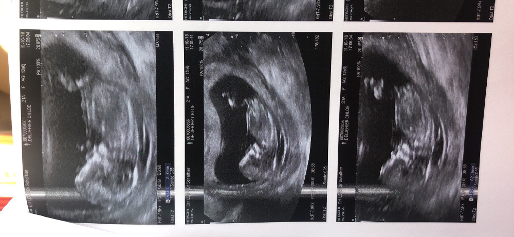 Cn 7 5 Mm Oedeme Amniocentese Forum Grossesse Amp Bebe Doctissimo Cn 7 5 Mm Oedeme Amniocentese Forum Grossesse Amp Bebe Doctissimo