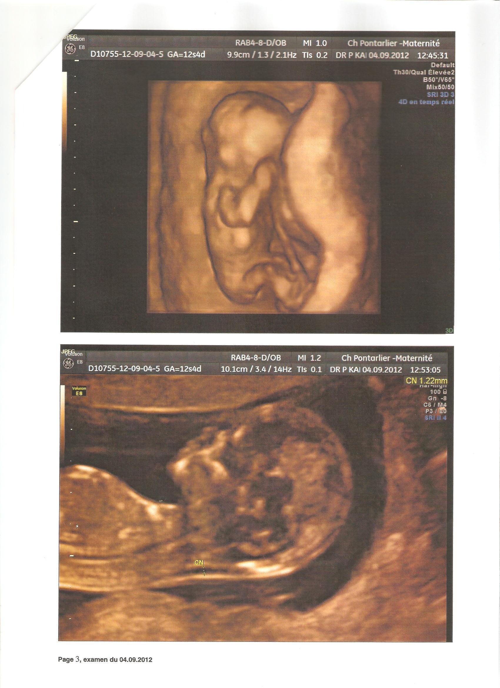 Votre Avis Sur Le Sexe 12sa 4 J Echographie Forum