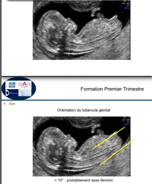 Bourgeon Explications Echographie Connaitre Le Sexe De Votre Bebe Forum Grossesse Amp Bebe Doctissimo