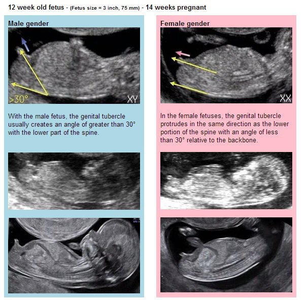 Bourgeon Explications Echographie Connaitre Le Sexe De Votre Bebe Forum Grossesse Amp Bebe Doctissimo Bourgeon Explications Echographie Connaitre Le Sexe De Votre Bebe Forum Grossesse Amp Bebe Doctissimo