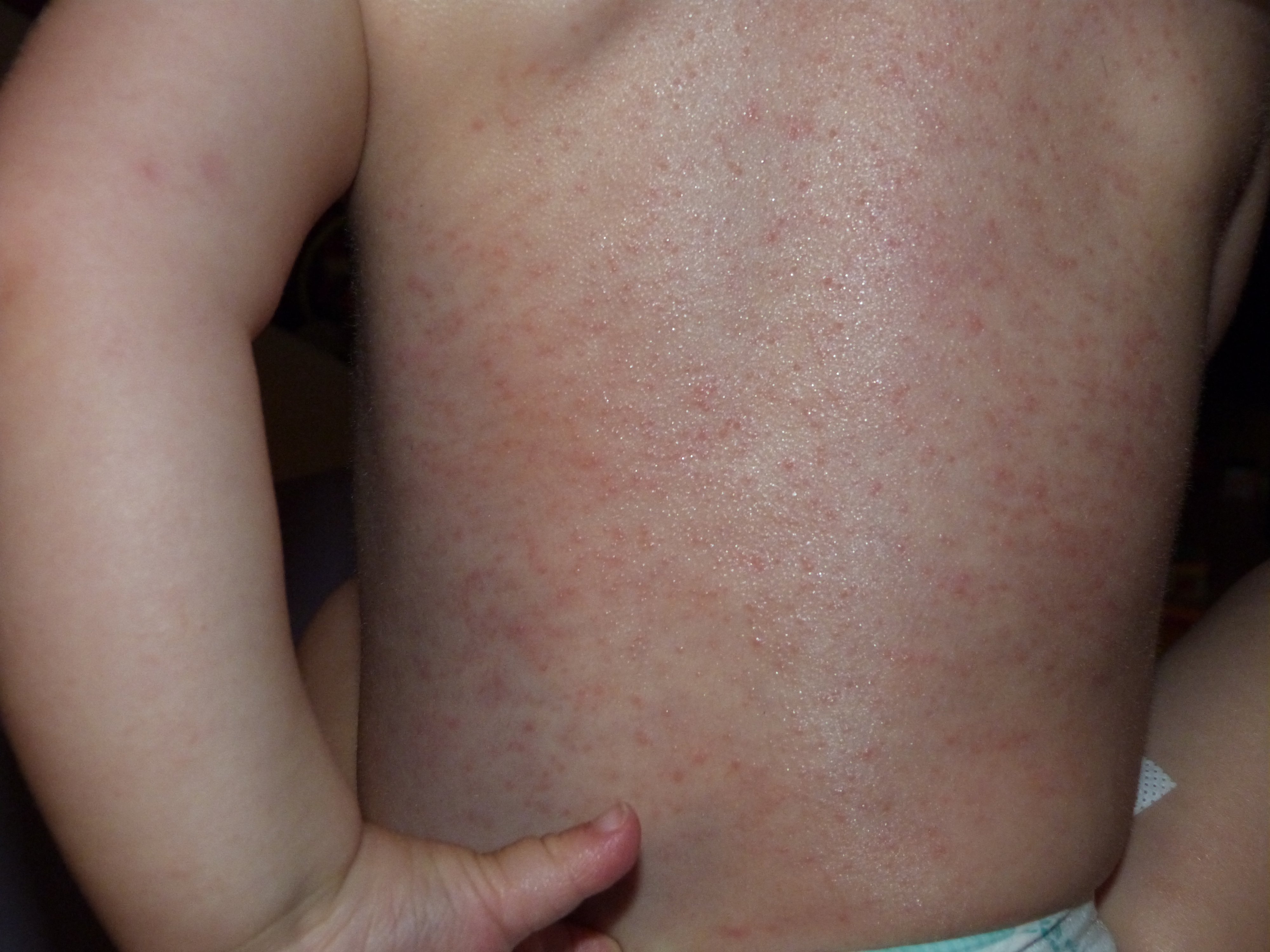 Bebe Avec Eczema Et Petits Boutons Allergies Et Eczema Forum Sante Doctissimo Bebe Avec Eczema Et Petits Boutons Allergies Et Eczema Forum Sante Doctissimo