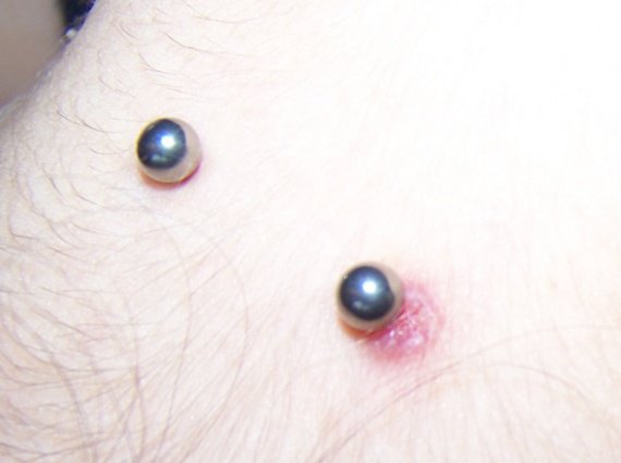 Piercing nuque qui ne cicatrise pas help - Tatouages et piercings ...