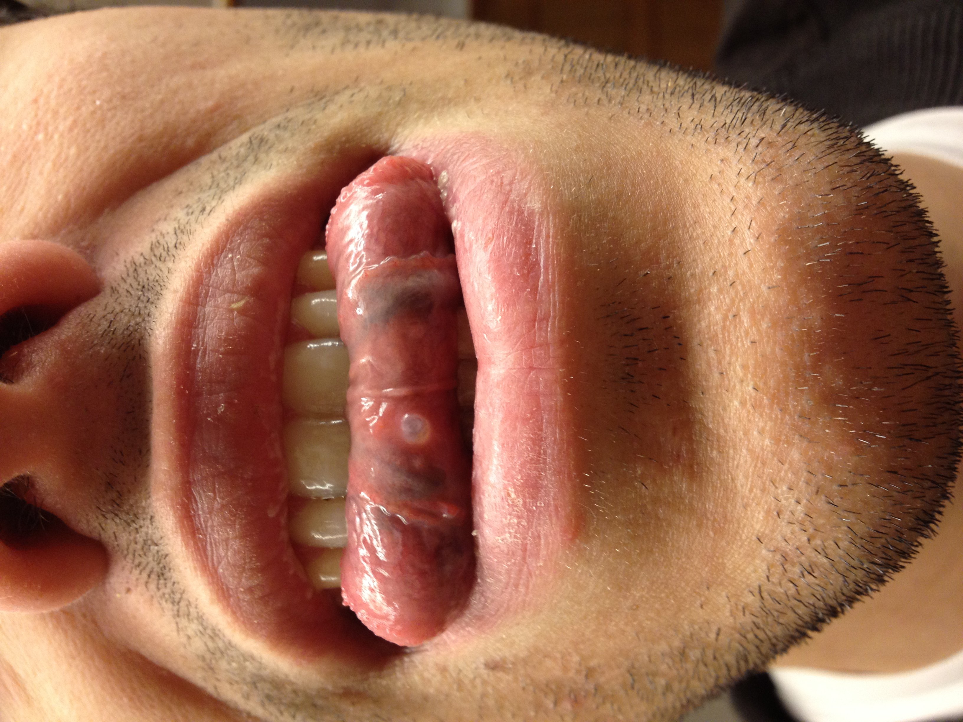 Bouton Sous La Langue Troubles Orl Forum Sante Doctissimo Bouton Sous La Langue Troubles Orl Forum Sante Doctissimo