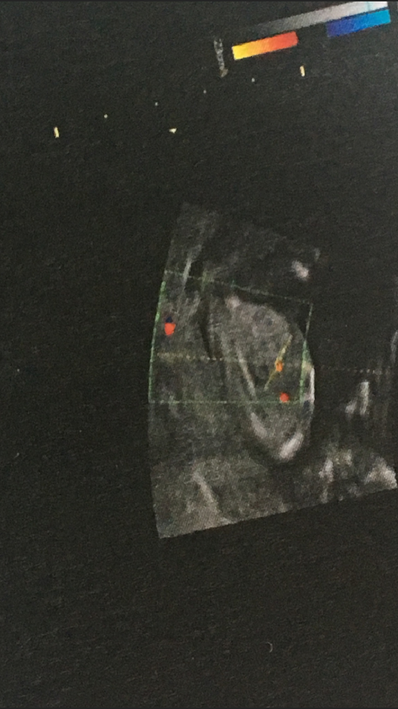 Deni De Grossesse Se Voit Sur Un Test écho des 12sa - Echographie - FORUM Grossesse & bébé