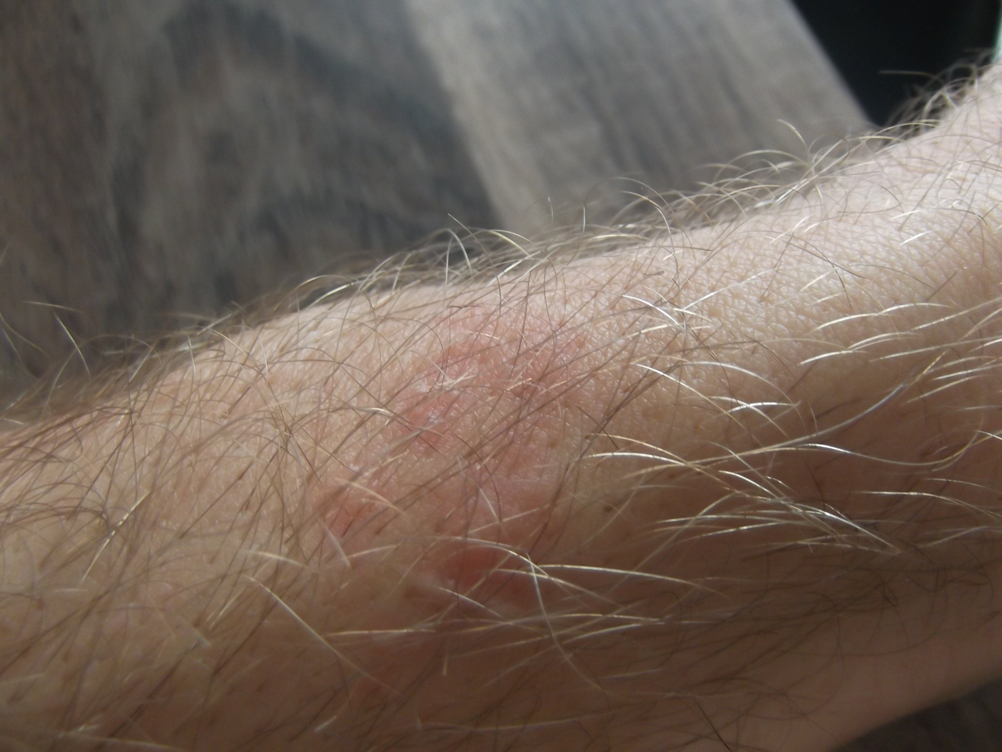 Petits Boutons En Plaque Demangeaison Mains Et Testicules Acne Psoriasis Et Problemes De Peau Forum Sante Doctissimo