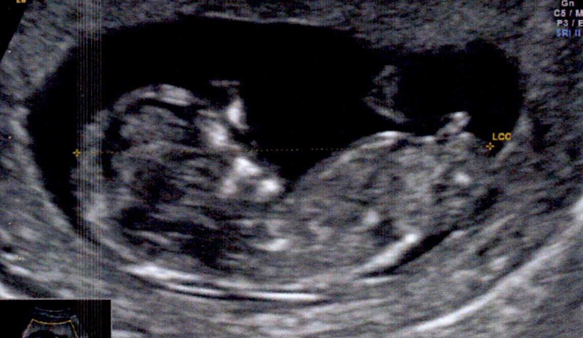 Echo 13sa Avec Tubercule Genital Fille Ou Garcon Echographie Connaitre Le Sexe De Votre Bebe Forum Grossesse Amp Bebe Doctissimo Echo 13sa Avec Tubercule Genital Fille Ou Garcon Echographie Connaitre Le Sexe De Votre Bebe Forum Grossesse Amp Bebe Doctissimo
