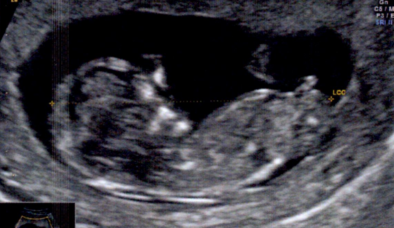 Echo 13sa Avec Tubercule Genital Fille Ou Garcon Echo 13sa Avec Tubercule Genital Fille Ou Garcon