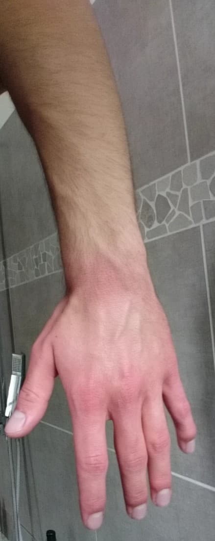 Main rouge sang - Traitement - Coronavirus - FORUM Santé