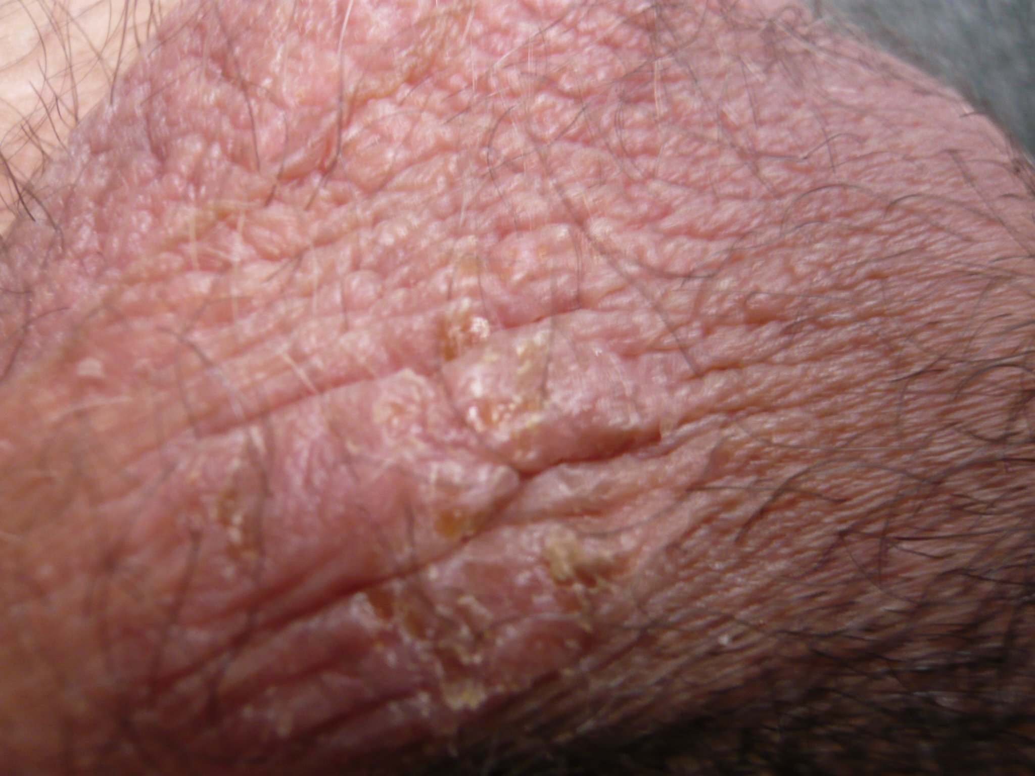 Des Plaies Qui Saignet Sur Les Testicules Infections Sexuellement Transmissibles Forum Sante Doctissimo