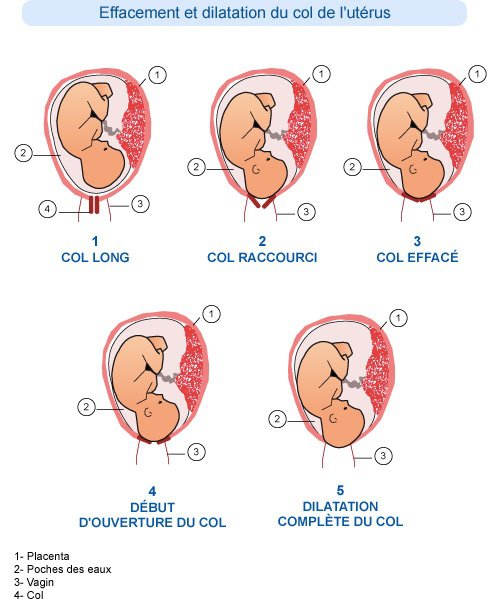 dilatation-uterus