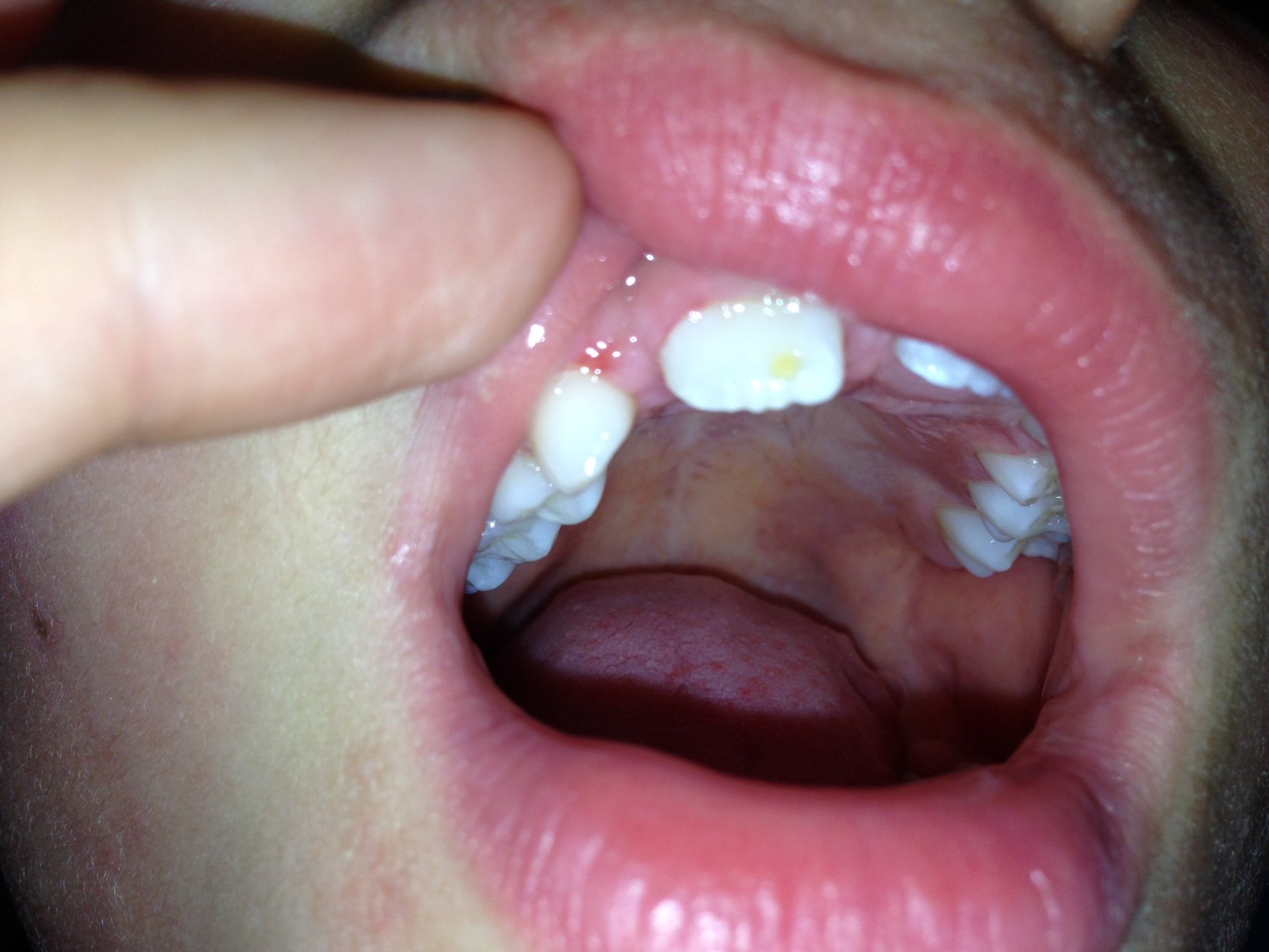 Dent Definitive Qui Pousse Avec Une Tache Jaune Problemes Dentaires Forum Sante Doctissimo Dent Definitive Qui Pousse Avec Une Tache Jaune Problemes Dentaires Forum Sante Doctissimo