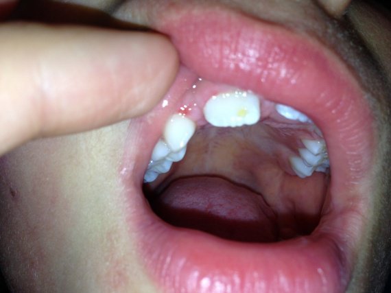 Dent Definitive Qui Pousse Avec Une Tache Jaune Dent Definitive Qui Pousse Avec Une Tache Jaune
