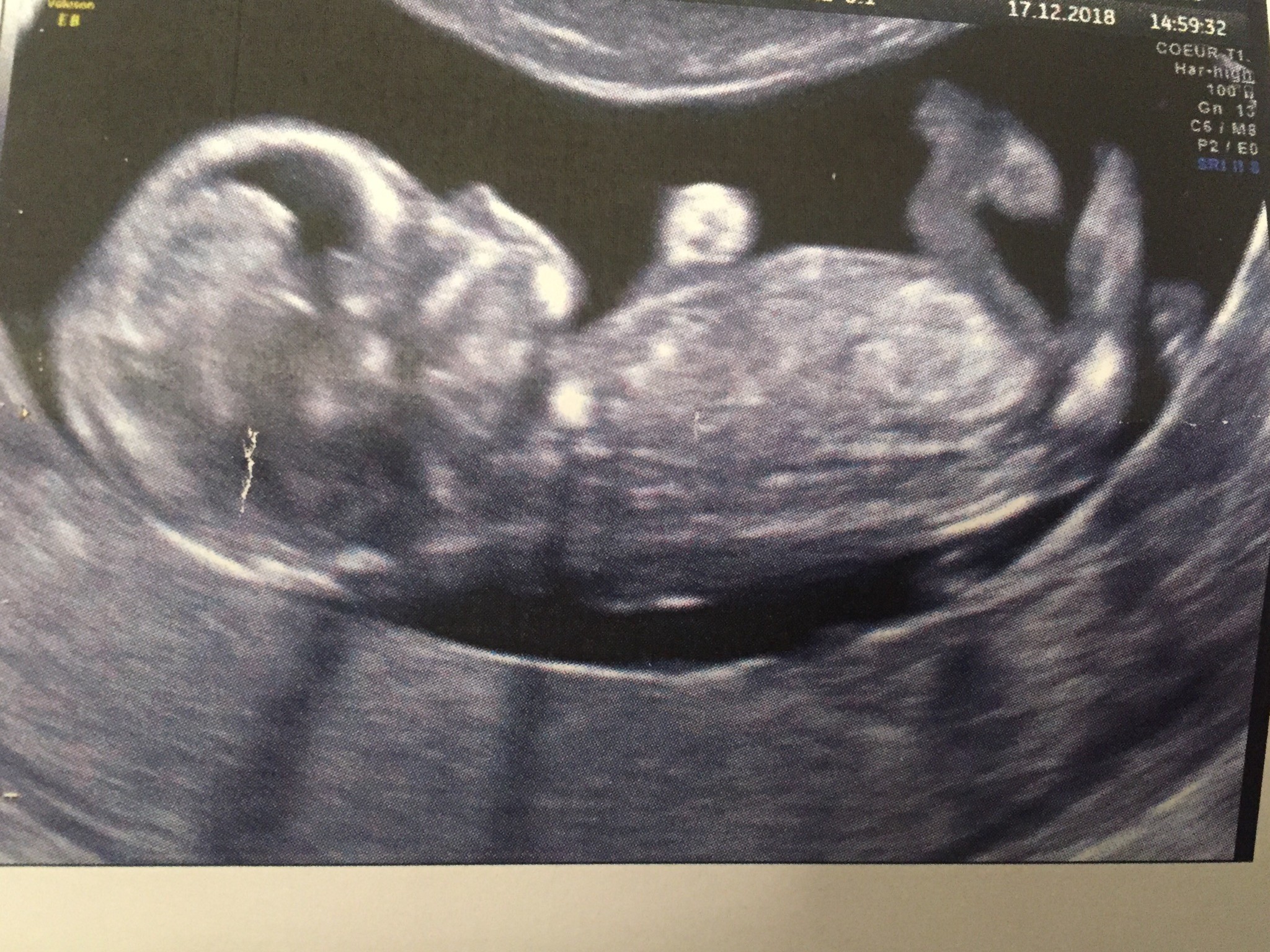 Echographie 10 Sg Votre Avis Echographie Connaitre Le Sexe De Votre Bebe Forum Grossesse Amp Bebe Doctissimo