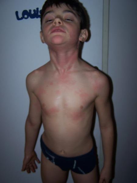 Allergie Votre Avis Allergie Votre Avis