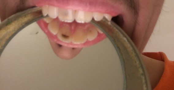 Tache Non Identifiee Derriere Mon Incisive Tache Non Identifiee Derriere Mon Incisive