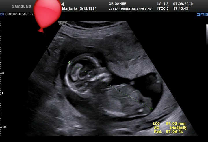 Echographie 14 Semaines Echographie Connaitre Le Sexe De Votre Bebe Forum Grossesse Amp Bebe Doctissimo Echographie 14 Semaines Echographie Connaitre Le Sexe De Votre Bebe Forum Grossesse Amp Bebe Doctissimo