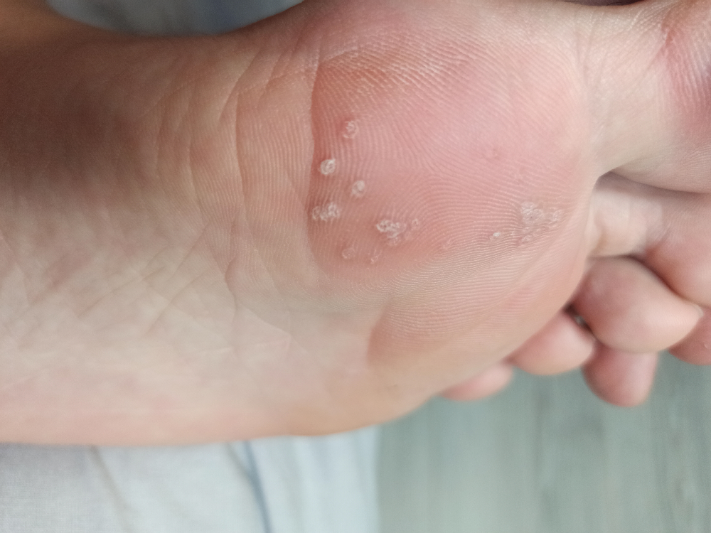 Plusieurs Petits Points Sous Le Pied Acne Psoriasis Et Problemes De Peau Forum Sante Doctissimo Plusieurs Petits Points Sous Le Pied Acne Psoriasis Et Problemes De Peau Forum Sante Doctissimo