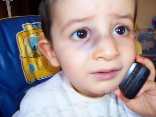 Tymeo Est Tombe Sur Le Nez Photos News Apres Visite Orl Bebe Grandit Forum Grossesse Amp Bebe Doctissimo Tymeo Est Tombe Sur Le Nez Photos News Apres Visite Orl Bebe Grandit Forum Grossesse Amp Bebe Doctissimo