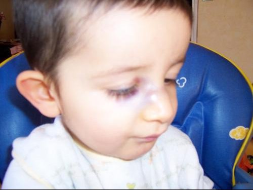 Tymeo Est Tombe Sur Le Nez Photos News Apres Visite Orl Bebe Grandit Forum Grossesse Amp Bebe Doctissimo Tymeo Est Tombe Sur Le Nez Photos News Apres Visite Orl Bebe Grandit Forum Grossesse Amp Bebe Doctissimo