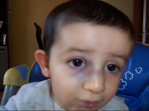 Tymeo Est Tombe Sur Le Nez Photos News Apres Visite Orl Bebe Grandit Forum Grossesse Amp Bebe Doctissimo Tymeo Est Tombe Sur Le Nez Photos News Apres Visite Orl Bebe Grandit Forum Grossesse Amp Bebe Doctissimo